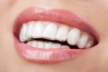Invisalign unsichtbare Zahnspange