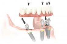 Nobel Biocare Implantate - All-on-4