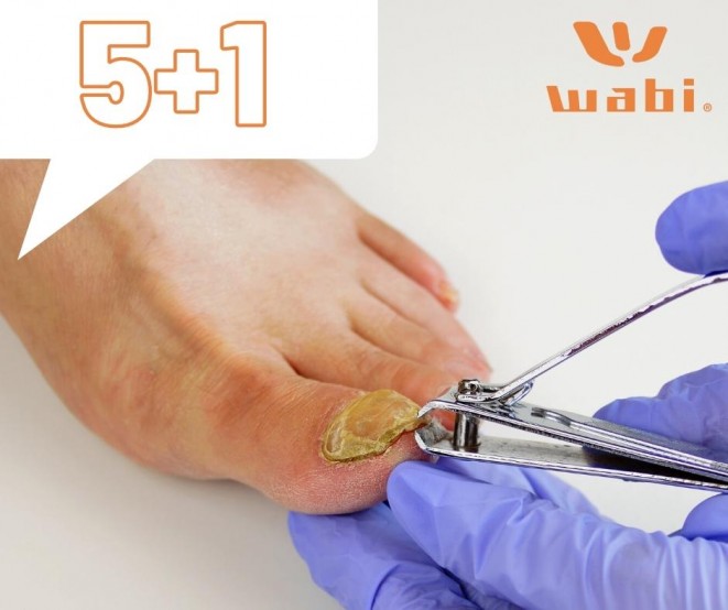 Verabschieden Sie sich vom Nagelpilz!  JETZT 5+1 Rabatt auf FOTONA Laser-Nagelpilz-Entfernung!